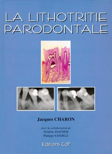 La Lithotritie parodontale 9782843610028