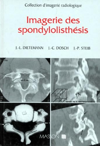 IMAGERIE DES SPONDYLOLISTHESIS 9782225845741