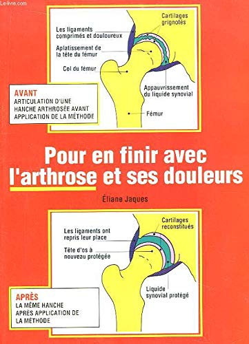 Pour en finir avec l'arthrose et ses douleurs . 