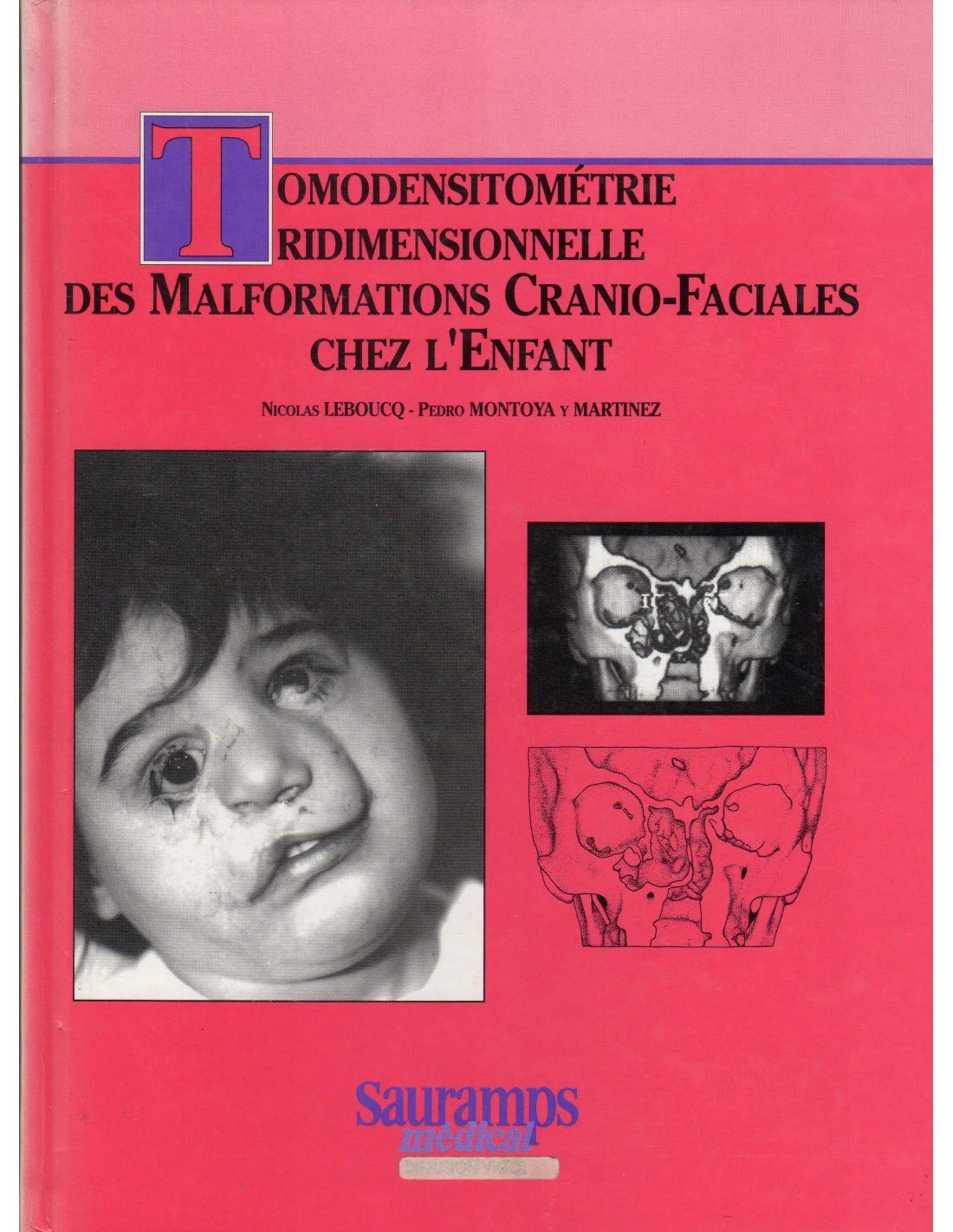 Tomodensitometrie tridimensionnelle des malformations cranio faciales de l enfant 9782905030610